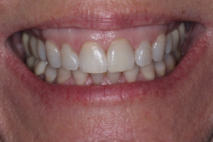 Elizabeth Weston (1)- Vestibuloplasty - Before