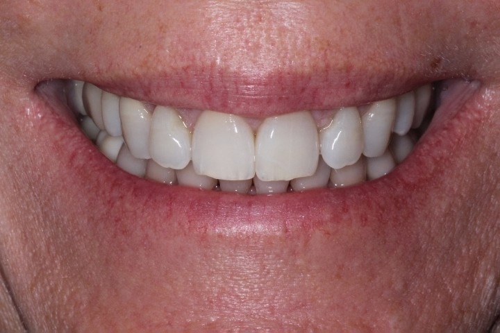 Elizabeth Weston (2)- Vestibuloplasty - After