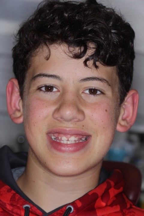 Michael Timme (1) - Before Gingivectomy (1)
