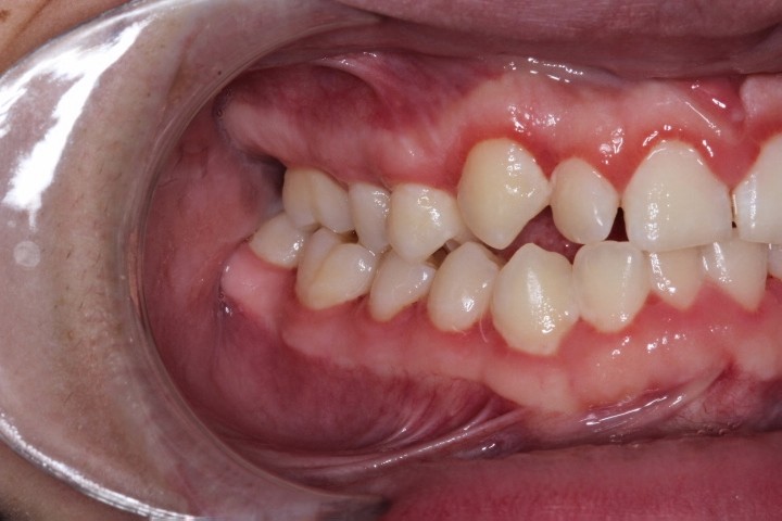Michael Timme (10) - After Gingivectomy (4)