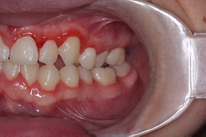 Michael Timme (11) - After Gingivectomy (5)