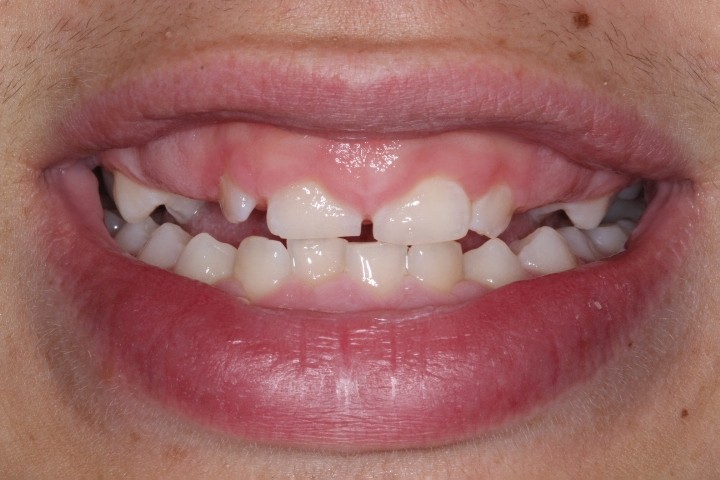 Michael Timme (2) - Before Gingivectomy (2)