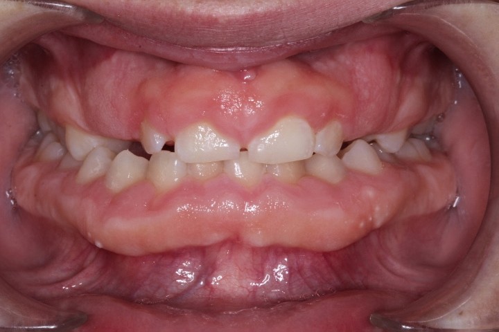 Michael Timme (3) - Before Gingivectomy (3)