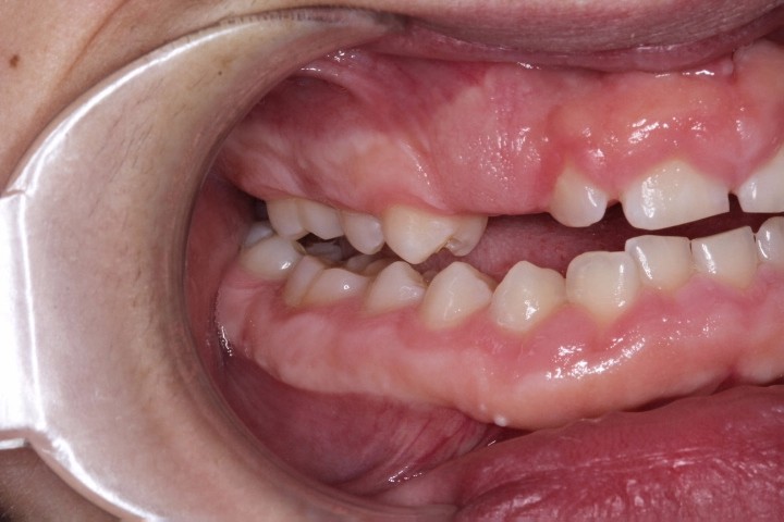 Michael Timme (5)- Before Gingivectomy (5)