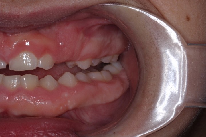 Michael Timme (6) - Before Gingivectomy (6)