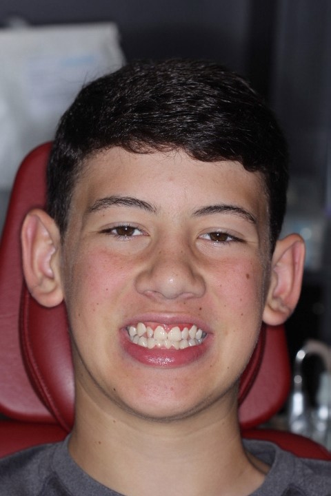 Michael Timme (7) - After Gingivectomy (1)