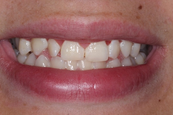 Michael Timme (8) - After Gingivectomy (2)