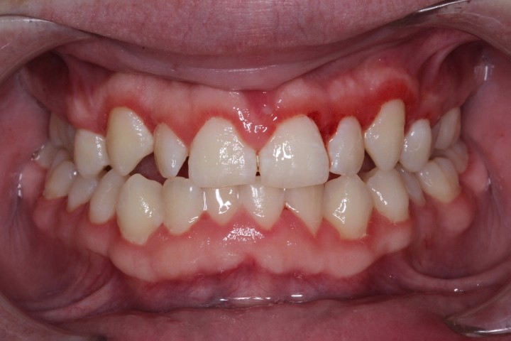 Michael Timme (9) - After Gingivectomy (3)