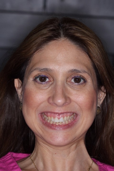 Myriam Ruiz (1) - Crown Lengthening UA - Before (1)