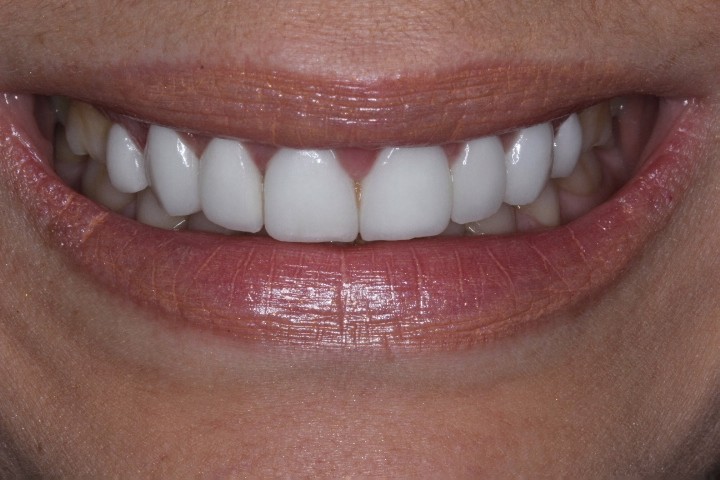 Myriam Ruiz (3) - Crown Lengthening - UA - After (1)