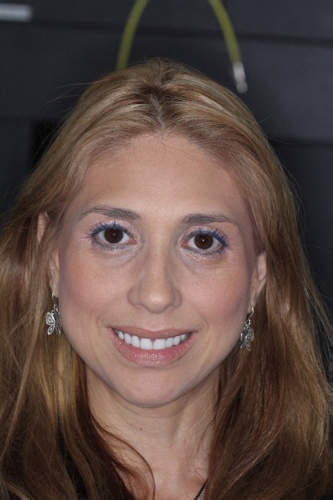Myriam Ruiz (4) - Crown Lengthening - UA - After (2) (1)